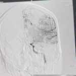 Медики врятували в Чернівцях 30-річного чоловіка з гострим ішемічним інсультом