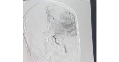 Медики врятували в Чернівцях 30-річного чоловіка з гострим ішемічним інсультом