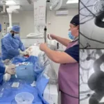У Чернівцях уперше провели унікальну операцію з лікування аневризми судин головного мозку