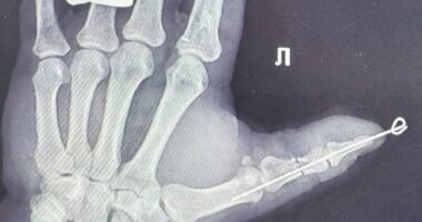 У Чернівцях лікарі вперше виконали унікальну операцію з реплантації повністю відрізаного великого пальця